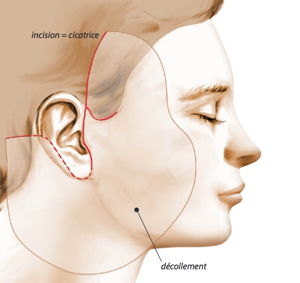 incisions lifting, opération lifting, lifting, lift, lift du visage, lifting lyon, lifting lausanne, lifting visage lyon, lifting visage lausanne, spécialiste lifting lyon, spécialiste lifting lausanne, lifting cervico-facial, lifting médio facial, lifting temporal, lifting endoscopique, tarif lifting visage, chirurgie visage prix, ovale du visage, lifting ovale du visage, combien coute un lifting, résultats lifting, lifting prix, photos lifting, lifting avant après