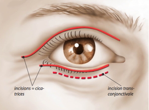 chirurgie paupières, chirurgie des paupières, opération des paupières, chirurgie paupière, chirurgie esthétique des yeux, chirurgie paupière lyon, chirurgie paupière lausanne, chirurgie esthétique des paupières supérieures, cernes, poches sous les yeux, blépharoplastie, blépharoplastie inférieure, blépharoplastie supérieure, chirurgien palpébral, spécialiste des paupières, chirurgie paupières ophtalmologie, chirurgie paupière prix, chirurgie paupière tombante, chirurgie paupières résultat, tarif chirurgie paupières, oculoplasticien