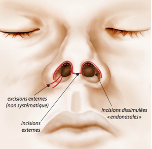 rhinoplastie, rhinoplastie lyon, rhinoplastie lausanne, spécialiste rhinoplastie, meilleur chirurgien du nez, rhinoplastie prix, coût rhinoplastie, rhinoplastie médicale, nez refait, opération du nez, rhinoplastie lyon meilleur chirurgien, chirurgie du nez, chirurgien esthétique du nez, prix rhinoplastie, rhinoplastie clinique du parc, rhinoplastie secondaire, rhinoplastie avant après, résultat rhinoplastie,