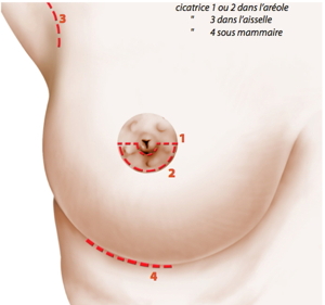 augmentation mammaire lyon, augmentation des seins lyon, augmentation seins lyon, augmentation des seins lausanne, augmentation seins lausanne, augmentation mammaire lausanne, augmentation des seins annecy, chirurgie des seins, chirugie des seins, chirurgie seins, chirugie seins, tarif augmentation mammaire lyon, implant mammaire, implants mammaires, prothèses mammaires, prothèses mammaires lyon, augmentation mammaire lyon prix, augmentation mammaire lausanne tarif, chirurgie mammaire, prothèses seins, prothèse mammaire, prothèses anatomiques, tarif augmentation mammaire, seins esthétique, seins Torossian, seins Lyon, seins Lausanne, opération seins, opération mammaire,