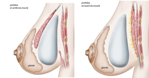 Mammaire, augmentation des seins, augmentation seins, augmentation mammaire, Mammaire lyon, augmentation des seins lyon, augmentation seins lyon, augmentation mammaire lyon, Mammaire lausanne, augmentation des seins lausanne, augmentation seins lausanne, augmentation mammaire lausanne, chirurgie des seins, chirugie des seins, chirurgie seins, chirugie seins, tarif augmentation mammaire lyon, implant mammaire, implants mammaires, prothèses mammaires, prothèses mammaires lyon, augmentation mammaire lyon prix, augmentation mammaire lausanne tarif, chirurgie mammaire, prothèses seins, prothèse mammaire, prothèses anatomiques, tarif augmentation mammaire, seins esthétique, seins Torossian, seins Lyon, seins Lausanne, opération seins, opération mammaire,