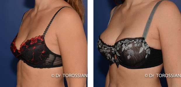 augmentation mammaire lyon, augmentation des seins lyon, augmentation seins lyon, augmentation des seins lausanne, augmentation seins lausanne, augmentation mammaire lausanne, augmentation des seins annecy, augmentation des seins saint etienne, augmentation des seins genève, augmentation des seins grenoble, augmentation des seins chambery, augmentation des seins valence, augmentation des seins dijon, chirurgie des seins, chirugie des seins, chirurgie seins, chirugie seins, tarif augmentation mammaire lyon, implant mammaire, implants mammaires, prothèses mammaires, prothèses mammaires lyon, augmentation mammaire lyon prix, augmentation mammaire lausanne tarif, chirurgie mammaire, prothèses seins, prothèse mammaire, prothèses anatomiques, tarif augmentation mammaire, seins esthétique, seins Torossian, seins Lyon, seins Lausanne, opération seins, opération mammaire