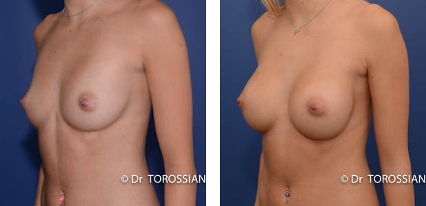 augmentation mammaire lyon, augmentation mamaire lyon, am lyon, chirurgie des seins lyon, chirurgie du sein lyon, chirurgie esthétique mammaire lyon, chirurgie Mammaire lyon, augmentation des seins lyon, augmentation seins lyon, prothese mammaire lyon, prothèses mammaires lyon , prothèses anatomiques lyon, implants mammaires lyon, implant mammaire tarif lyon, prix augmentation mammaire lyon, mammoplastie lyon, chirurgie esthétique lyon, augmentation mammaire lausanne, augmentation des seins lausanne, augmentation seins lausanne, augmentation mamaire lausanne, augmentation mammaire annecy, augmentation mammaire genève, augmentation mammaire grenoble, augmentation mammaire chambery, augmentation mammaire valence, augmentation mammaire dijon, tarif augmentation mammaire lyon, chirurgie des seins lausanne, chirurgie des seins valence, chirurgie des seins annecy, chirurgie des seins genève, chirurgie du sein lyon, chirurgie du sein lausanne,