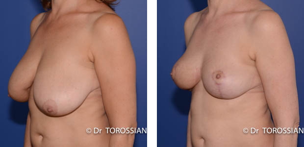 reconstruction mammaire, lipofilling mammaire, lipofilling reconstruction mammaire, prothèse mammaire, plastie mammaire, lipofilling sein, seins asymétriques, seins tubéreux, malformation sein, seins tubéreux