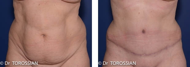 abdominoplastie, abdominoplastie lausanne, chirurgie esthétique lyon, chirurgie réparatrice du ventre lyon, chirurgie du ventre lyon, tablier abdominal, cicatrice de césarienne, ventre lyon, ventre forcé lyon, ventre grossesse, vergetures ventre, opération esthétique du ventre lyon, chirurgien abdominoplastie lyon, abdominoplastie lausanne, chirurgie esthétique du ventre lyon, chirurgie plastique du ventre lyon, chirurgie réparatrice du ventre, plastie abdominale lausanne, abdominaux, meilleur chirurgien du ventre lyon, expert chirurgie esthétique, lifting du ventre lyon, lifting du ventre photos, lifting ventre après grossesse, plastie abdominale lyon, abdominoplastie lyon, prise en charge sécurité sociale,