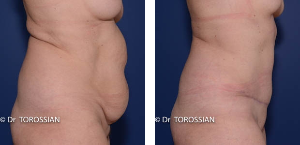 abdominoplastie, abdominoplastie lausanne, chirurgie esthétique lyon, chirurgie réparatrice du ventre lyon, chirurgie du ventre lyon, tablier abdominal, cicatrice de césarienne, ventre lyon, ventre forcé lyon, ventre grossesse, vergetures ventre, opération esthétique du ventre lyon, chirurgien abdominoplastie lyon, abdominoplastie lausanne, chirurgie esthétique du ventre lyon, chirurgie plastique du ventre lyon, chirurgie réparatrice du ventre, plastie abdominale lausanne, abdominaux, meilleur chirurgien du ventre lyon, expert chirurgie esthétique, lifting du ventre lyon, lifting du ventre photos, lifting ventre après grossesse, plastie abdominale lyon, abdominoplastie lyon, prise en charge sécurité sociale,