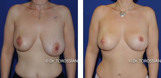 chirurgie des seins lyon, chirurgie des seins lausanne, chirurgie des seins valence, chirurgie des seins annecy, chirurgie des seins genève, chirurgie du sein lyon, chirurgie du sein lausanne, chirurgie esthetique mammaire lyon, chirurgie esthetique mammaire lausanne, chirurgie mammaire lyon, chirurgie mammaire lausanne, chirurgie mammaire valence, chirurgie mammaire chambéry, chirurgie mammaire annecy, mammoplastie lyon, mammoplastie lausanne, prix chirurgie mammaire lyon, prix chirurgie mammaire lausanne, peie mammaire lyon, pexie mammaire lausanne, augmentation mammaire lyon augmentation mammaire lausanne, tarif lifting des seins lyon, tarif lifting des seins lausanne, lifting mammaire lyon, lifting mammaire lausanne, ptôse mammaire lyon, ptôse mammaire lausanne, hypertrophie mammaire lyon, hypertrophie mammaire lausanne, mammoplastie de réduction lyon, seins lourds lyon, asymétrie mammaire lyon, asymétrie mammaire lausanne, chirurgie esthétique lyon