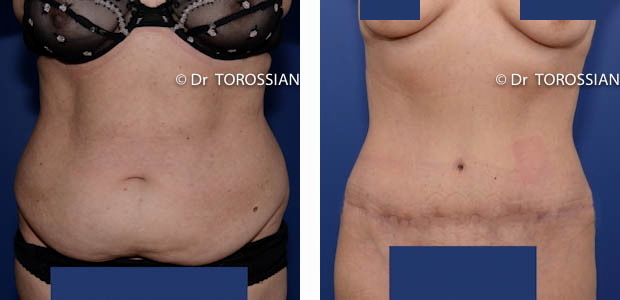 chirurgie esthétique lyon, chirurgie esthetique ventre lyon, chirurgie esthetique ventre lausanne, abdominoplastie lyon, abdominoplastie lausanne, chirurgien abdominoplastie lyon, chirurgien abdominoplastie lausanne, prix abdominoplastie lyon, prix abdominoplastie lausanne, tarif abdominoplastie lyon, liposuccion du ventre lyon, liposuccion du ventre lausanne