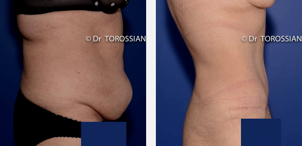 chirurgie esthétique lyon, chirurgie esthetique ventre lyon, chirurgie esthetique ventre lausanne, abdominoplastie lyon, abdominoplastie lausanne, chirurgien abdominoplastie lyon, chirurgien abdominoplastie lausanne, prix abdominoplastie lyon, prix abdominoplastie lausanne, tarif abdominoplastie lyon, liposuccion du ventre lyon, liposuccion du ventre lausanne