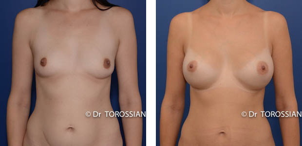 chirurgie esthétique lyon, augmentation mammaire lyon, augmentation des seins lyon, augmentation seins lyon, augmentation des seins lausanne, augmentation seins lausanne, augmentation mammaire lausanne, augmentation des seins annecy, chirurgie des seins lyon, chirurgie des seins lausanne, chirurgie des seins valence, chirurgie des seins annecy, chirurgie des seins genève, chirurgie du sein lyon, chirurgie du sein lausanne, chirurgie esthetique mammaire lyon, chirurgie esthetique mammaire lausanne, chirurgie mammaire lyon, chirurgie mammaire lausanne, chirurgie mammaire valence, chirurgie mammaire chambéry, chirurgie mammaire annecy, mammoplastie lyon, mammoplastie lausanne, prix chirurgie mammaire lyon, prix chirurgie mammaire lausanne, augmentation mamaire lyon, augmentation mamaire lausanne, augmentation mamaire genève, augmentation mammaire lyon, augmentation mammaire lausanne, augmentation mammaire prix lyon, augmentation mammaire prix lausanne, prix augmentation mammaire lyon, prix augmentation mammaire lausanne, tarif augmentation mammaire lyon, tarif augmentation mammaire lausanne, implant mammaire lyon, implant mammaire lausanne, implant mammaire tarif lyon, implant mammaire tarif lausanne, implants mammaires lyon, implants mammaires lausanne, prothese mammaire lyon, prothese mammaire lausanne, prothese mammaire valence, prothese mammaire grenoble, prothese mammaire chambéry, bon chirurgien esthetique lyon, bon chirurgien esthetique lausanne, cabinet esthetique lyon, cabinet esthetique lausanne, chirurgie plastique lyon, chirurgie plastique lausanne, chirurgien esthetique lyon, chirurgien esthetique lausanne, chirurgien plasticien lyon, chirurgien plasticien lausanne, chirurgien plastique lyon, chirurgien plastique lausanne, clinique chirurgie esthétique lyon, clinique chirurgie esthétique l lausanne, meilleur chirurgien esthetique lyon, meilleur chirurgien esthetique lausanne, tarif chirurgie esthetique lyon, tarif chirurgie esthetique lausanne,