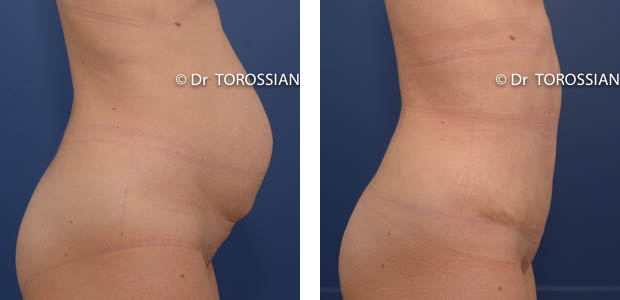 chirurgie esthétique lyon, chirurgie esthetique ventre lyon, chirurgie esthetique ventre lausanne, abdominoplastie lyon, abdominoplastie lausanne, chirurgien abdominoplastie lyon, chirurgien abdominoplastie lausanne, prix abdominoplastie lyon, prix abdominoplastie lausanne, tarif abdominoplastie lyon, liposuccion du ventre lyon, liposuccion du ventre lausanne