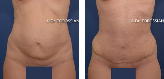 chirurgie esthétique lyon, chirurgie esthetique ventre lyon, chirurgie esthetique ventre lausanne, abdominoplastie lyon, abdominoplastie lausanne, chirurgien abdominoplastie lyon, chirurgien abdominoplastie lausanne, prix abdominoplastie lyon, prix abdominoplastie lausanne, tarif abdominoplastie lyon, liposuccion du ventre lyon, liposuccion du ventre lausanne