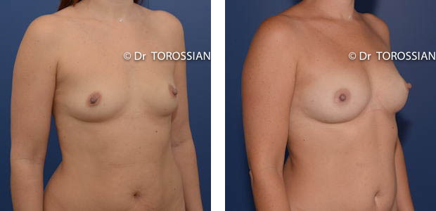 lipofilling mammaire lyon, lipoffiliing lyon, lipofilling lausanne, chirurgie esthétique lyon, chirurgie esthétique lausanne, sein lyon, sein lausanne, chirurgie esthétique lyon, chirurgien esthétique lyon, Lifting des seins lyon, lifting des seins lausanne, chirurgie des seins lyon, chirurgie des seins lausanne, chirurgie des seins valence, chirurgie des seins annecy, chirurgie des seins genève, chirurgie du sein lyon, chirurgie du sein lausanne, chirurgie esthetique mammaire lyon, chirurgie esthetique mammaire lausanne, chirurgie mammaire lyon, chirurgie mammaire lausanne, chirurgie mammaire valence, chirurgie mammaire chambéry, chirurgie mammaire annecy, mammoplastie lyon, mammoplastie lausanne, prix chirurgie mammaire lyon, prix chirurgie mammaire lausanne, peie mammaire lyon, pexie mammaire lausanne, augmentation mammaire lyon, augmentation mammaire lausanne, tarif lifting des seins lyon, tarif lifting des seins lausanne, lifting mammaire lyon, lifting mammaire lausanne, ptôse mammaire lyon, ptôse mammaire lausanne 