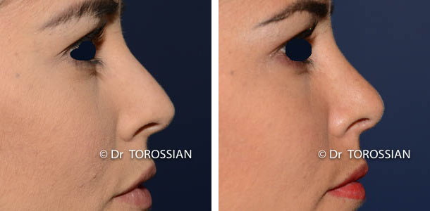 Rhinoplastie conservatrice Lyon, Rhinoplastie lyon, Rhinoplastie Lausanne, Rhinoplastie Genève, Rhinoplastie Annecy, Rhinoplastie Grenoble, Rhinoplastie Saint Etienne, Rhinoplastie Valence, Rhinoplastie esthétique lyon, Rhinoplastie esthétique Lausanne, Rhinoplastie esthétique Genève, Rhinoplastie esthétique Annecy, Rhinoplastie esthétique Grenoble, Rhinoplastie esthétique Saint Etienne, Rhinoplastie esthétique Valence, spécialiste rhinoplastie lyon, , rhinoplastie prix lyon, coût rhinoplastie lyon, rhinoplastie médicale lyon, nez refait lyon, chirurgie du nez lyon, chirurgien esthétique du nez lyon, chirurgien esthétique du nez Lausanne, rhinoplastie clinique du parc lyon, chirurgien esthétique lyon