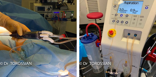 Lipoaspiration lyon, liposculture lyon, lipoaspiration lausanne, lipoaspiration annecy