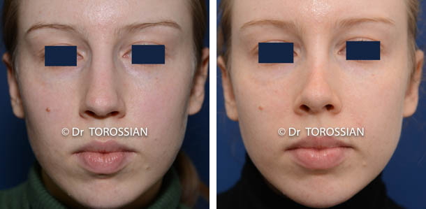 Rhinoplastie esthétique 