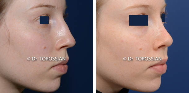 Rhinoplastie esthétique 