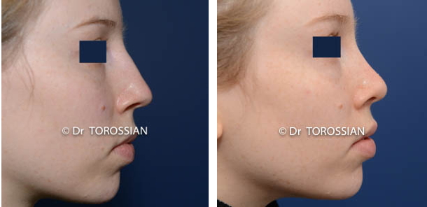 Rhinoplastie esthétique 