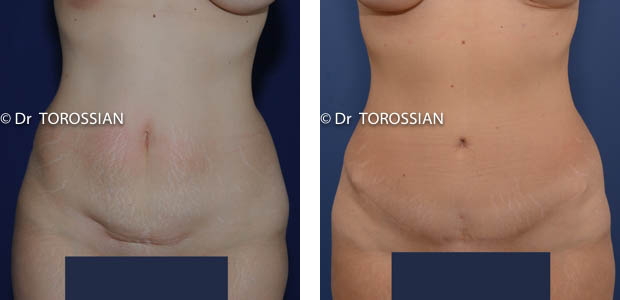 Minilift abdominal lyon, abdominoplastie lyon, lipoaspiration lyon, ombilicoplastie lyon, Minilift abdominal  lausanne, abdominoplastie  lausanne, lipoaspiration  lausanne, ombilicoplastie lausanne, 