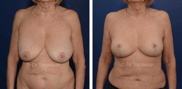 Explantation mammaire à Lyon et Lausanne, résultats avant après, ablation de prothèses mammaires, retrait implants mammaires, lifting des seins à Genève, Annecy Chambéry et Valence.
