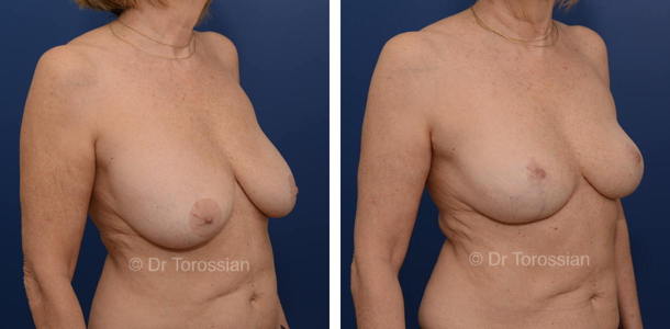 Explantation mammaire à Lyon et Lausanne, résultats avant après, ablation de prothèses mammaires, retrait implants mammaires, lifting des seins à Genève, Annecy Chambéry et Valence.